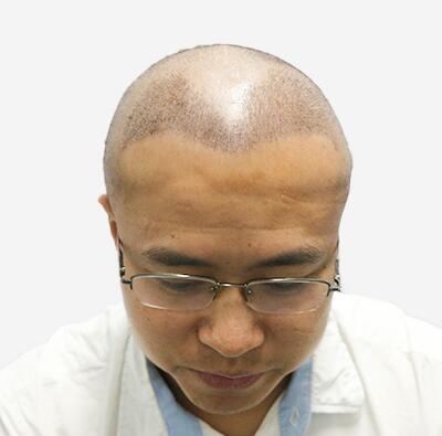 摆脱发型不好的日子，植发让程序员小哥摆脱发型困扰！