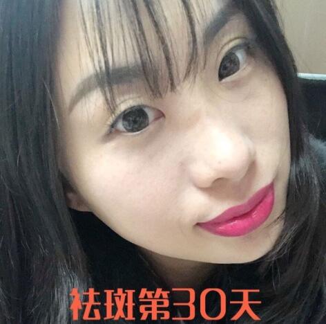 蚌埠祛斑激光术后果图