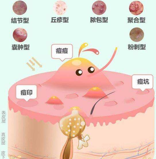 痘疤怎么去除