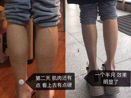 注射瘦腿