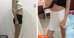 韩式共振吸脂减肥真实案例分享！看我好身材的修炼秘籍！