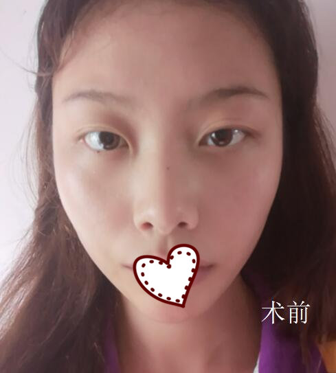 深圳星妍医疗美容隆鼻案例分享