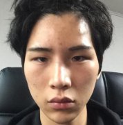 男生颧骨颧弓整形亲测体验分享，精致男人硬朗不失美感！