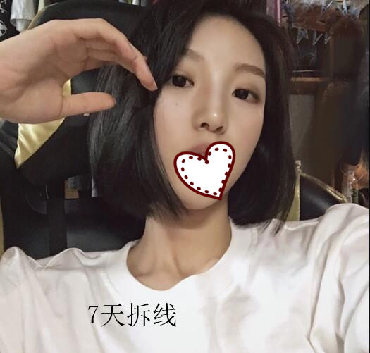 北京南加国际整形隆鼻案例