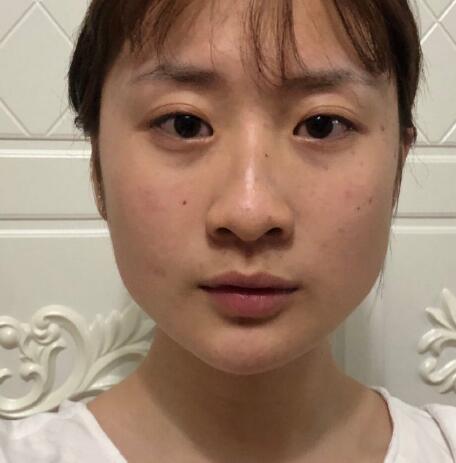 上海九院柴岗磨骨手术案例分享