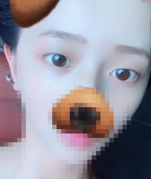 北京八大处赵延勇医生做双眼皮怎么样?