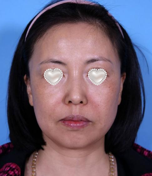 面部拉皮去皱整形果图分享