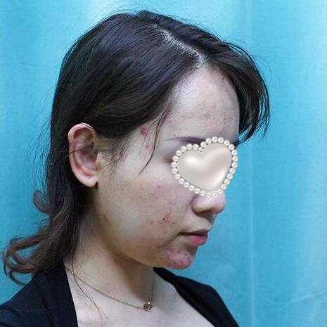 深圳四季医疗美容面部吸脂案例分享
