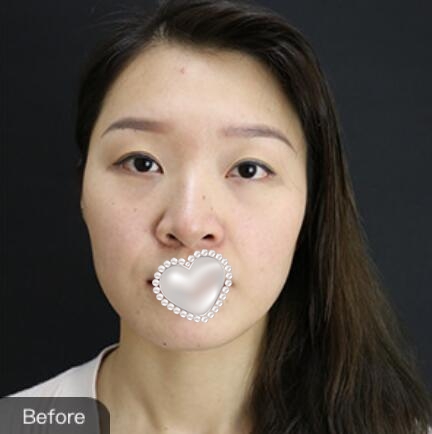 热玛吉除皱果图