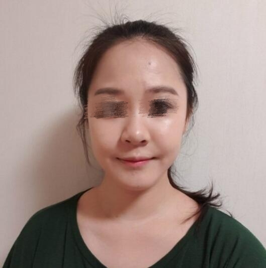 硅胶隆鼻整形术果图