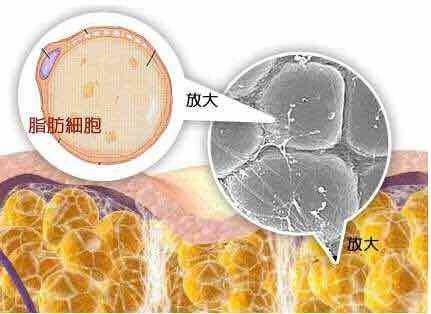 王洪医生科普腰腹吸脂手术