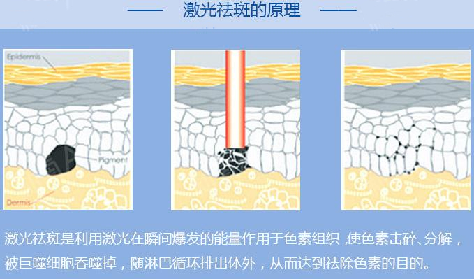 蓝宝石激光祛斑原理简介