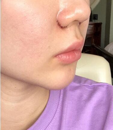 鼻头鼻翼鼻尖整形过程日记分享