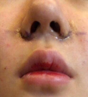 鼻头鼻翼鼻尖整形恢复期全纪录!分享果图,蒜鼻姐妹pick me!