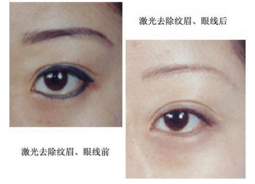 激光洗眼线整形手术的伤害