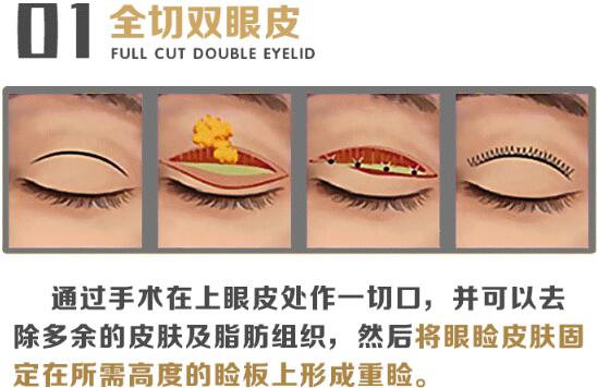 八大处宋涛医生双眼皮知识科普