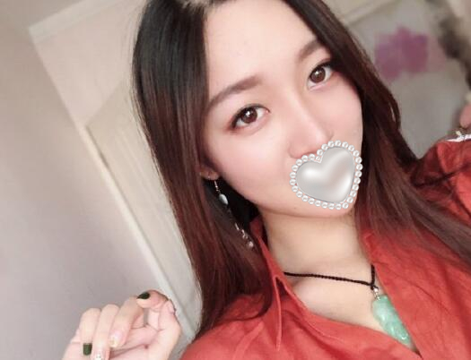 衡阳雅美姚江华医生脂肪填充​案例