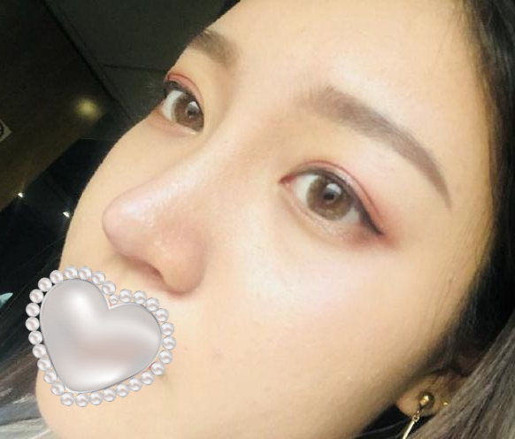 衡阳雅美姚江华医生脂肪填充​案例