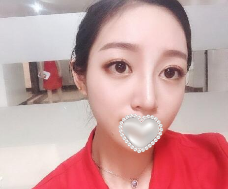 衡阳雅美姚江华医生脂肪填充​案例