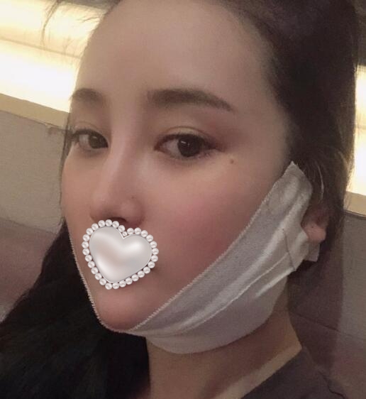 面部吸脂瘦脸手术果对比