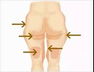 襄阳中心医院科普大腿吸脂手术
