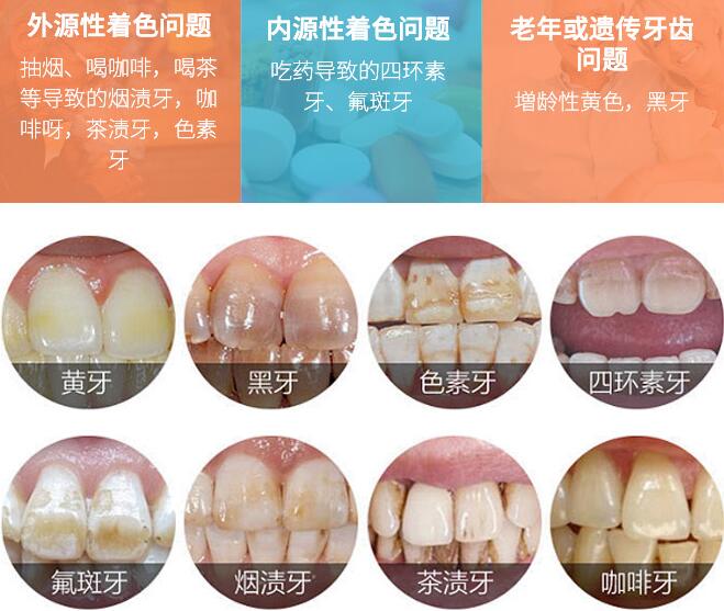南京口腔医院科普如何美白牙齿较有