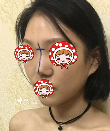 北京协和医院整形外科黄渭清医生隆鼻案例​