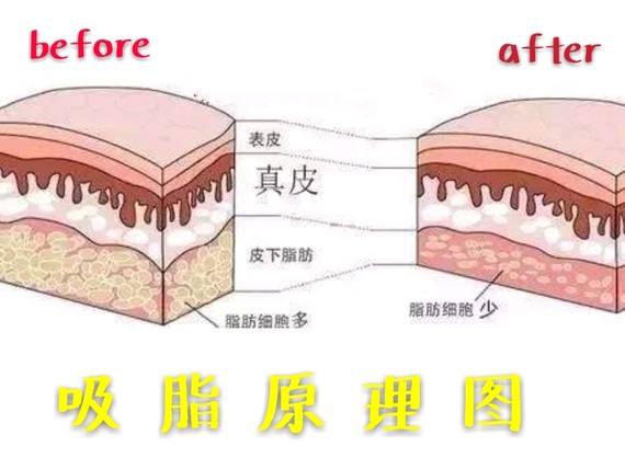 北京芭迪星美汇医疗美容科普大腿吸脂手术