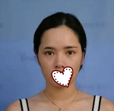 玻尿酸隆鼻果图分享