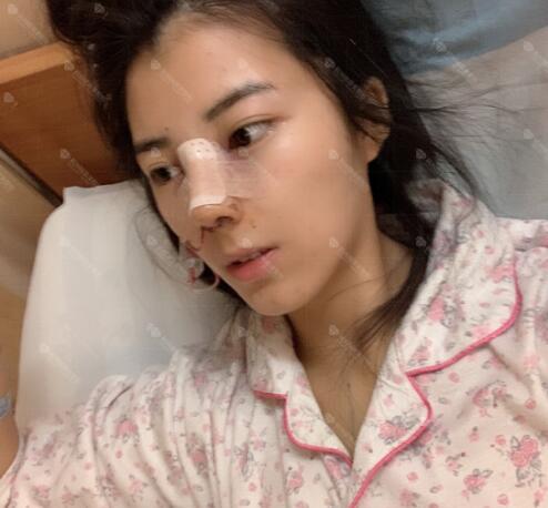 专业隆鼻整形手术体验