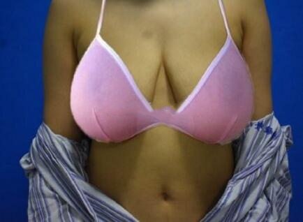 奥美定取出手术日记