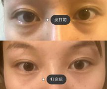 玻尿酸填充泪沟没问题吗？看我靓眼果图！魅力轻松get！