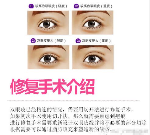 王维医生科普双眼皮修复手术相关知识