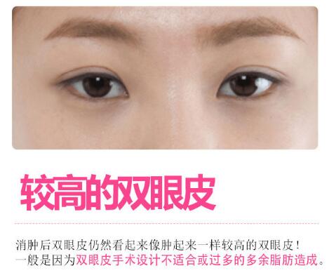 王维医生科普双眼皮修复手术相关知识