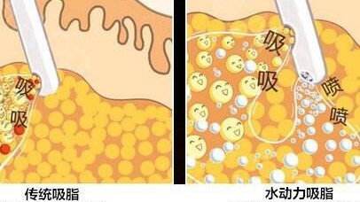 福田庆三医生科普吸脂手术