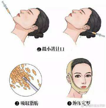 吴一医生科普面部吸脂手术