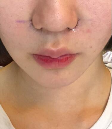 鼻翼缩小整形手术体验日记