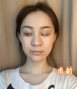 做隆鼻手术好吗？我的恢复全过程分享！变美日记坦露心理变化！