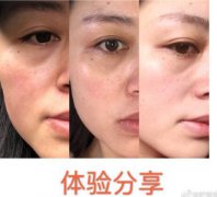 光子嫩肤果怎么样？让我的亲身测评美照来征服你！