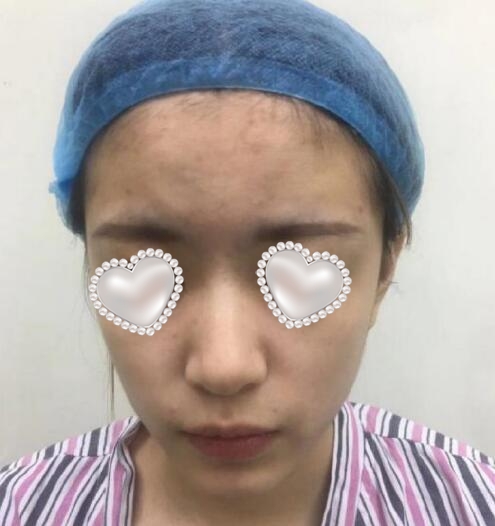 重庆西南整形外科毋巨龙医生隆鼻案例