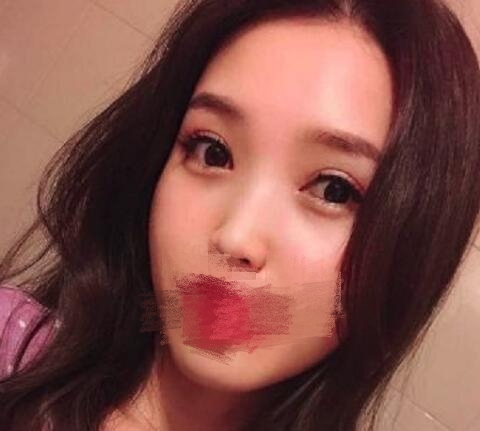 张自强医生做双眼皮果图