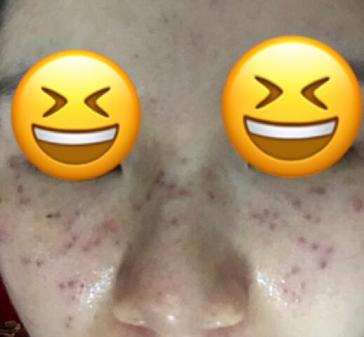 秦皇岛巧致整形张凯华医生激光美肤祛斑案例分享