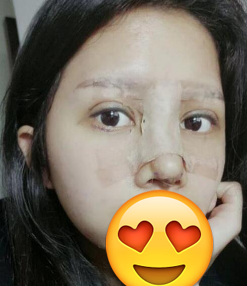 南方医科大南方整形姜平医生隆鼻案例分享