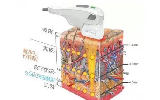 李成明医生科普面部抗衰项目超声提拉
