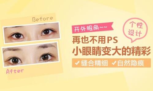 开外眼角适合的人群有哪些