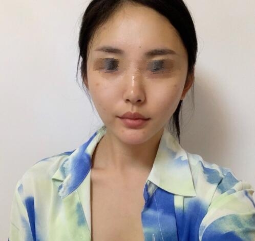 上海九院余东医生颧骨整形案例分享