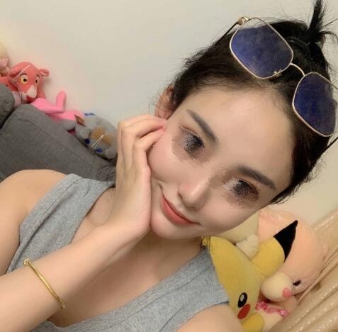 上海九院余东医生颧骨整形案例分享