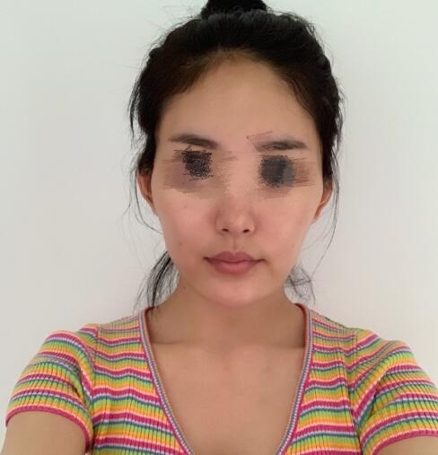 上海九院余东医生颧骨整形案例分享