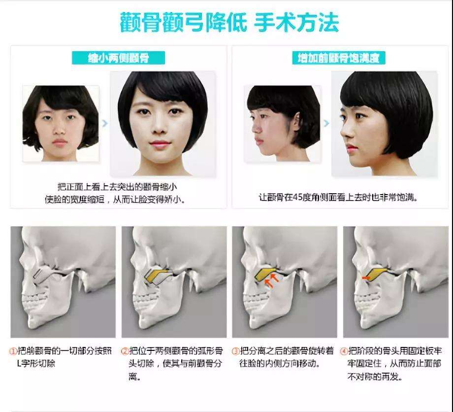 上海九院余东医生科普颧骨整形的两种方法