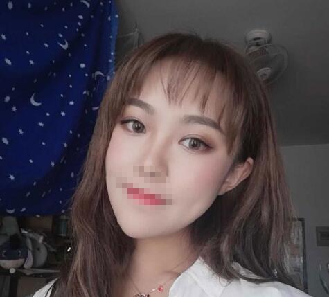 中山大学附属第二医院整形修复外科双眼皮案例